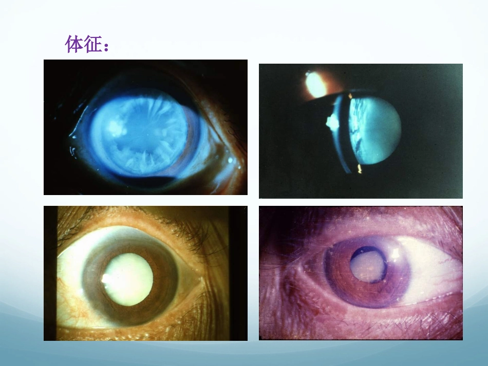 白内障_第6页