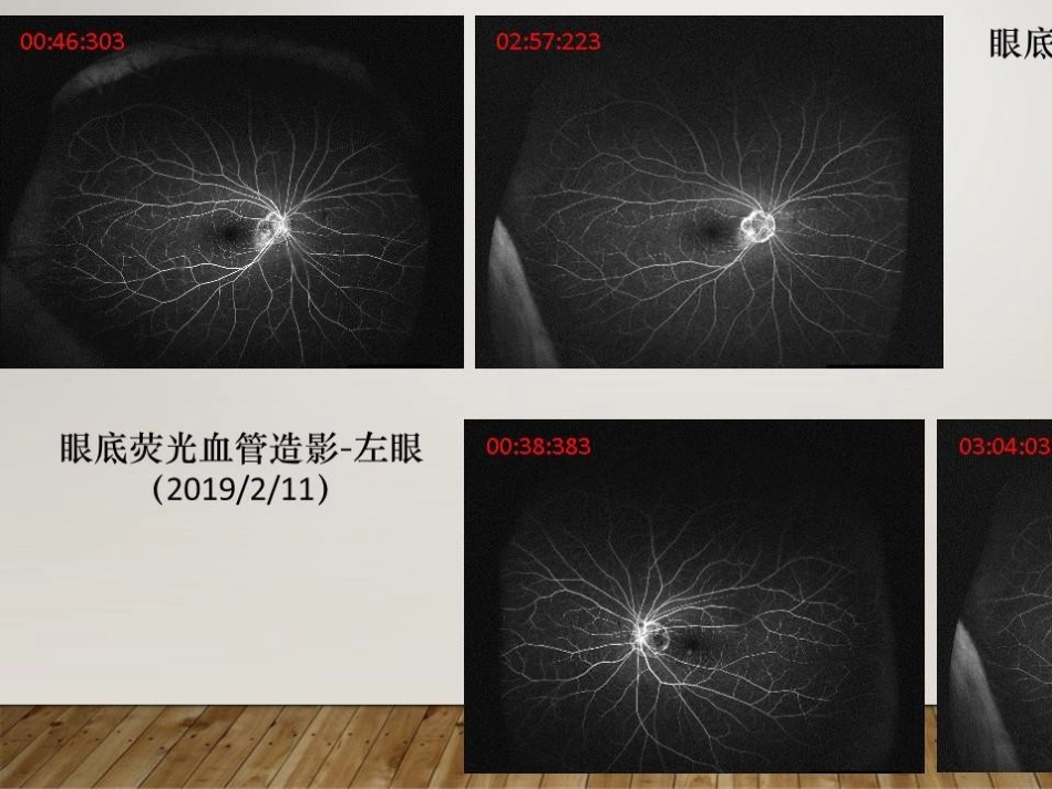 癌相关性自身免疫性视网膜病变_第10页