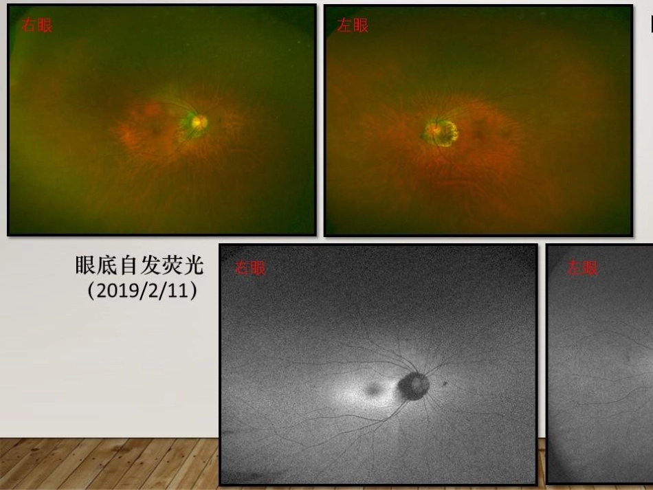 癌相关性自身免疫性视网膜病变_第11页