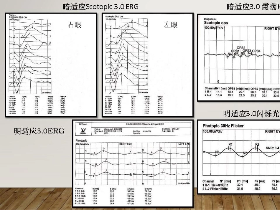 癌相关性自身免疫性视网膜病变_第12页