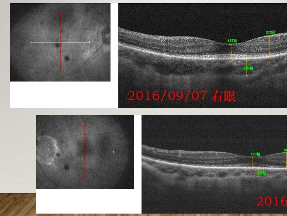 癌相关性自身免疫性视网膜病变_第5页