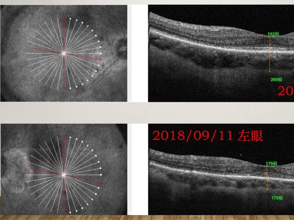 癌相关性自身免疫性视网膜病变_第6页