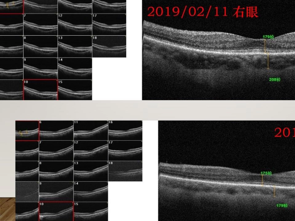 癌相关性自身免疫性视网膜病变_第8页