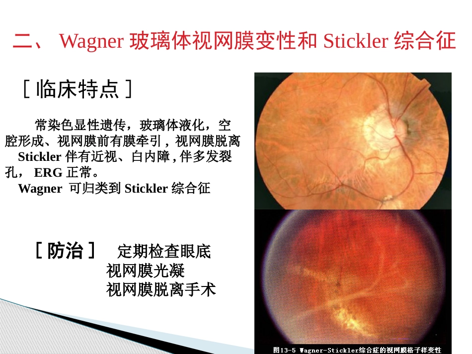 玻璃体病,视网膜病 PPT_第10页
