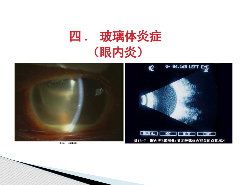 玻璃体病,视网膜病 PPT_第12页