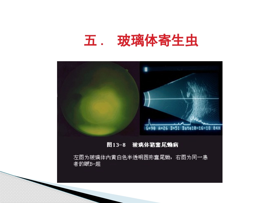 玻璃体病,视网膜病 PPT_第13页