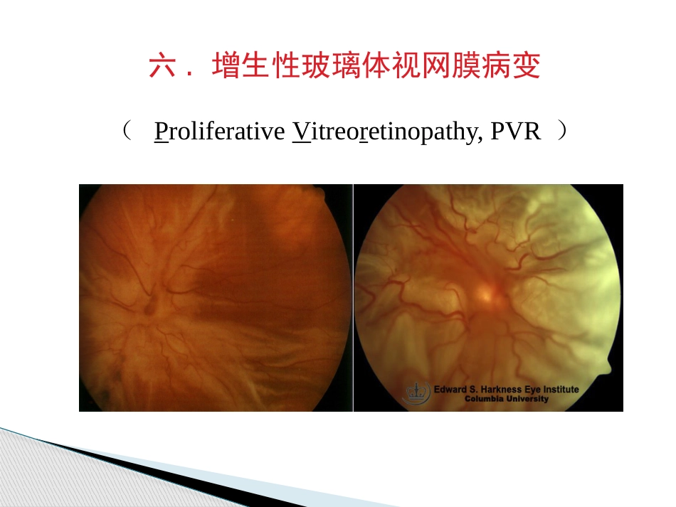 玻璃体病,视网膜病 PPT_第14页