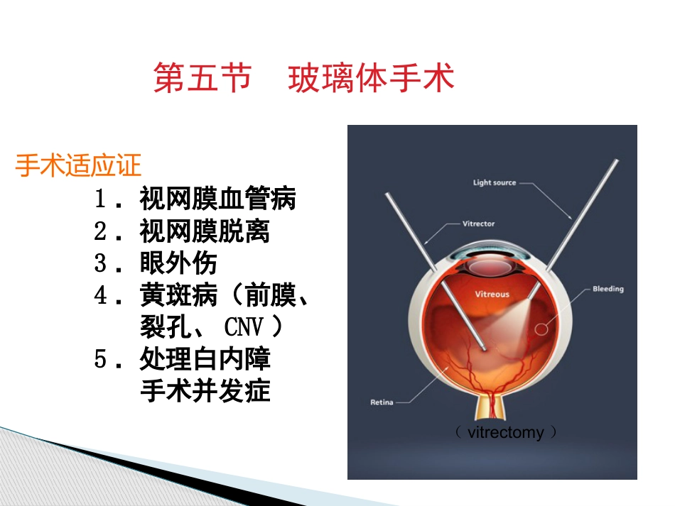 玻璃体病,视网膜病 PPT_第15页