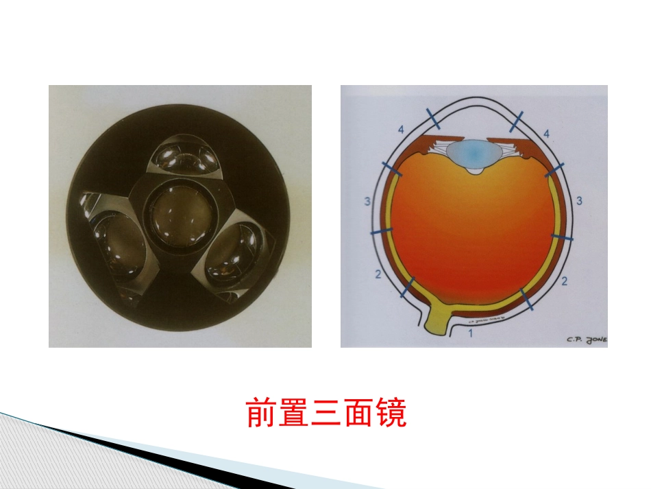玻璃体病,视网膜病 PPT_第4页