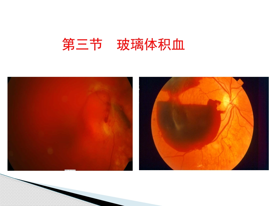 玻璃体病,视网膜病 PPT_第7页