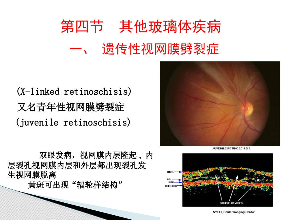 玻璃体病,视网膜病 PPT_第9页