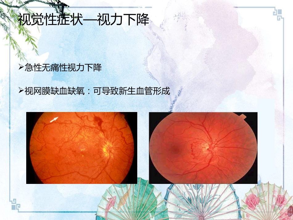 【眼科学基础】眼科症状学_第13页
