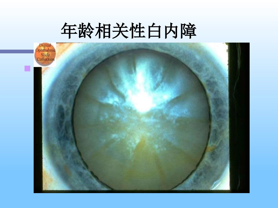 白内障及护理_第13页
