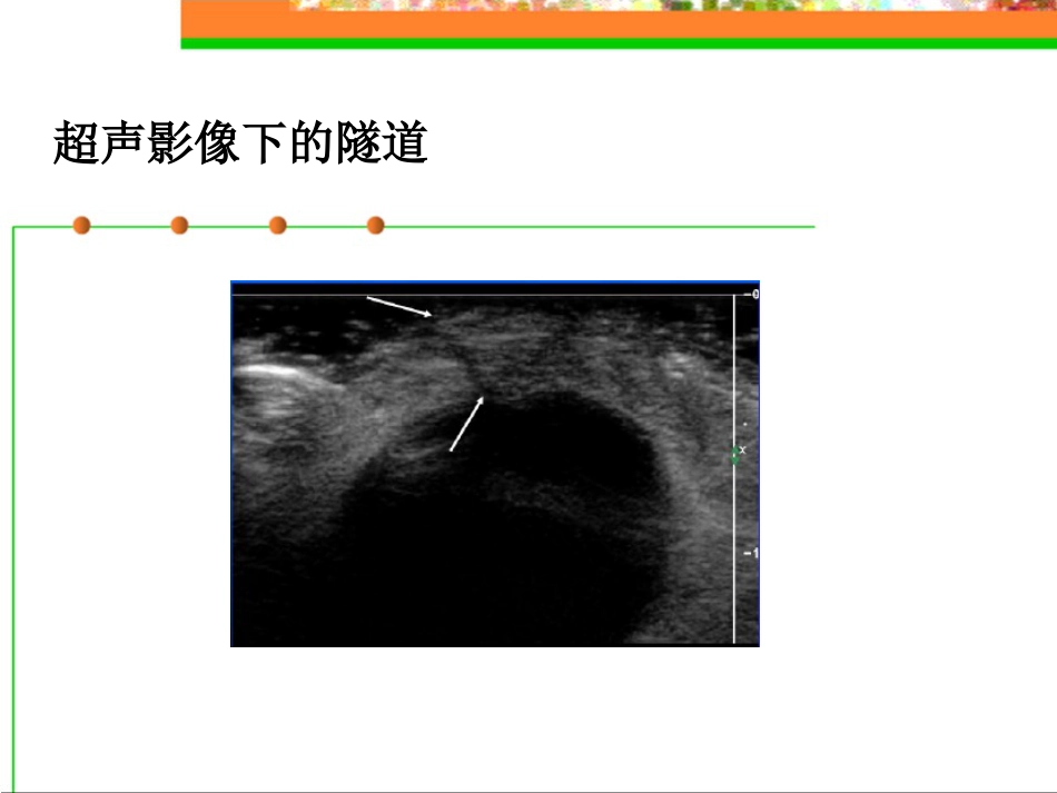 钝针扣眼法在临床中的应用ppt_第10页