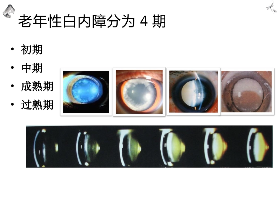 常见的眼科疾病科普_第14页