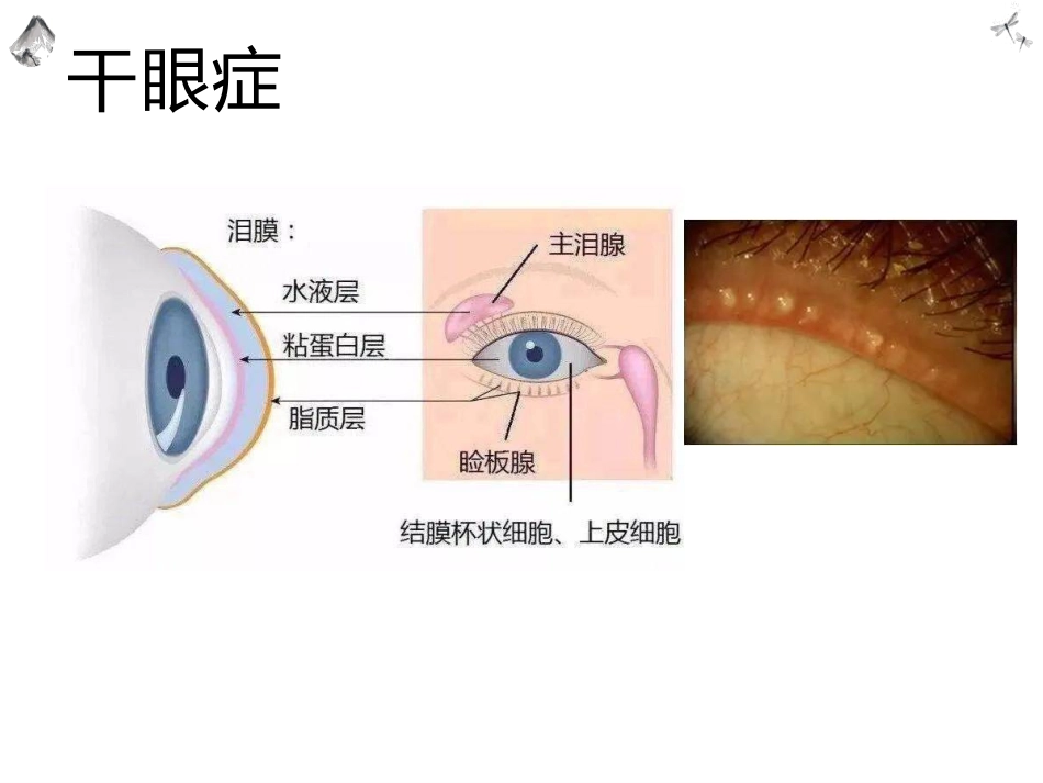 常见的眼科疾病科普_第5页