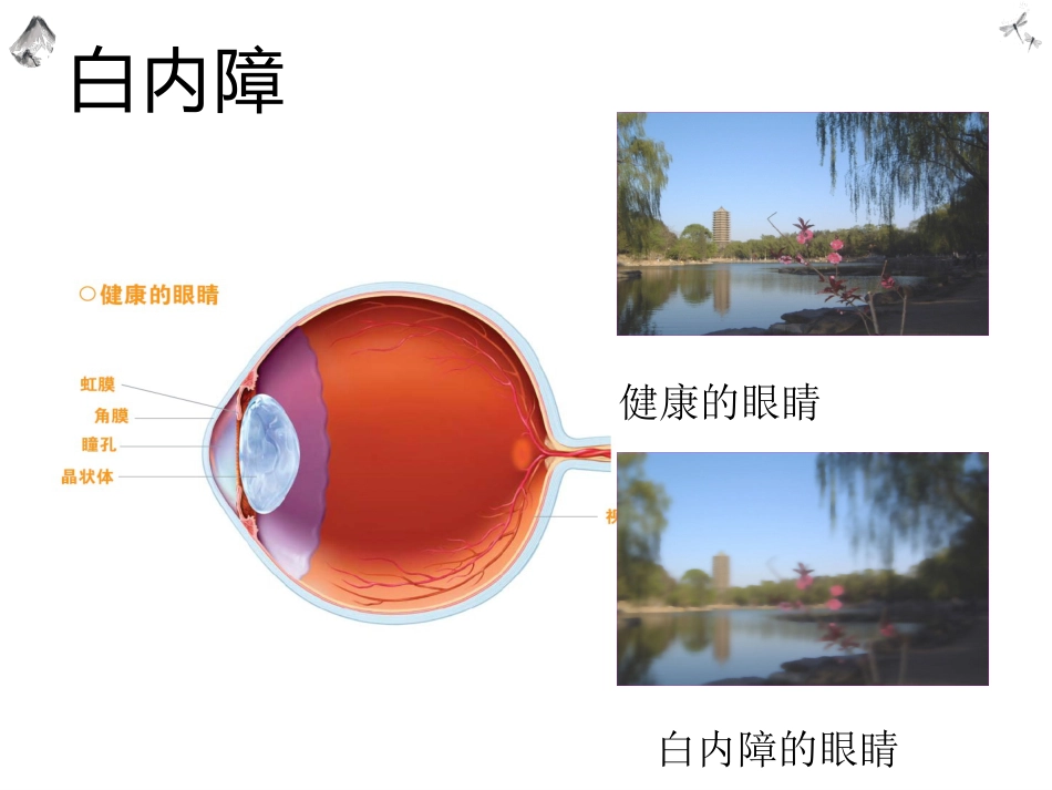 常见的眼科疾病科普_第8页