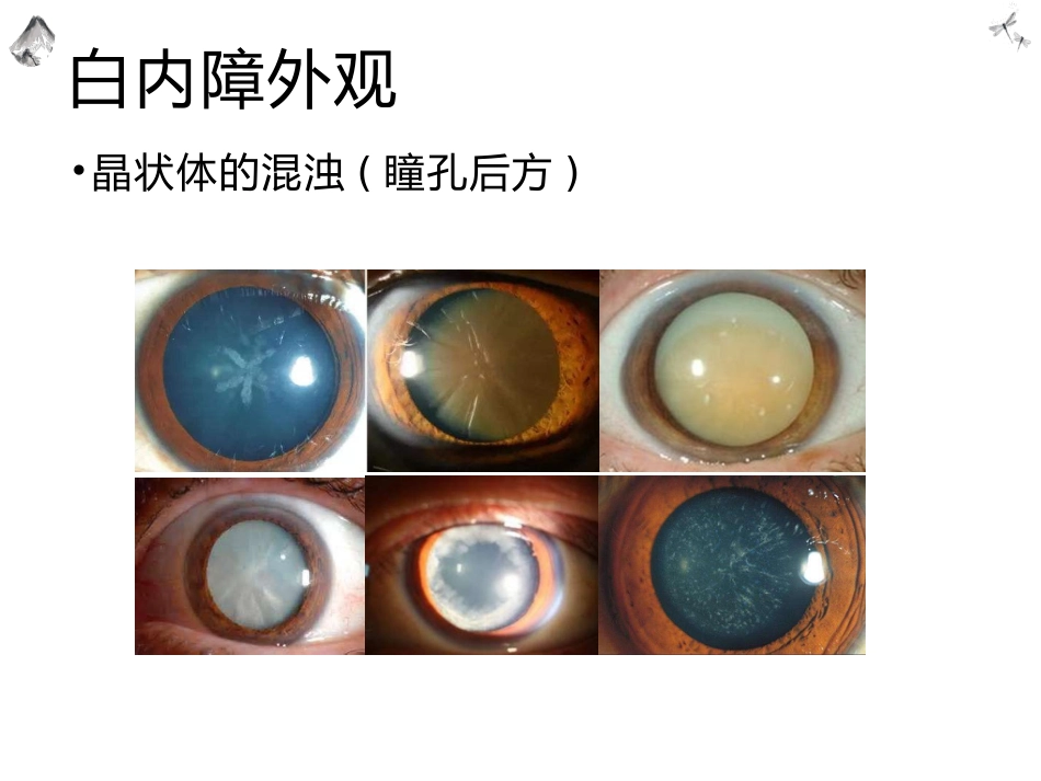 常见的眼科疾病科普_第9页