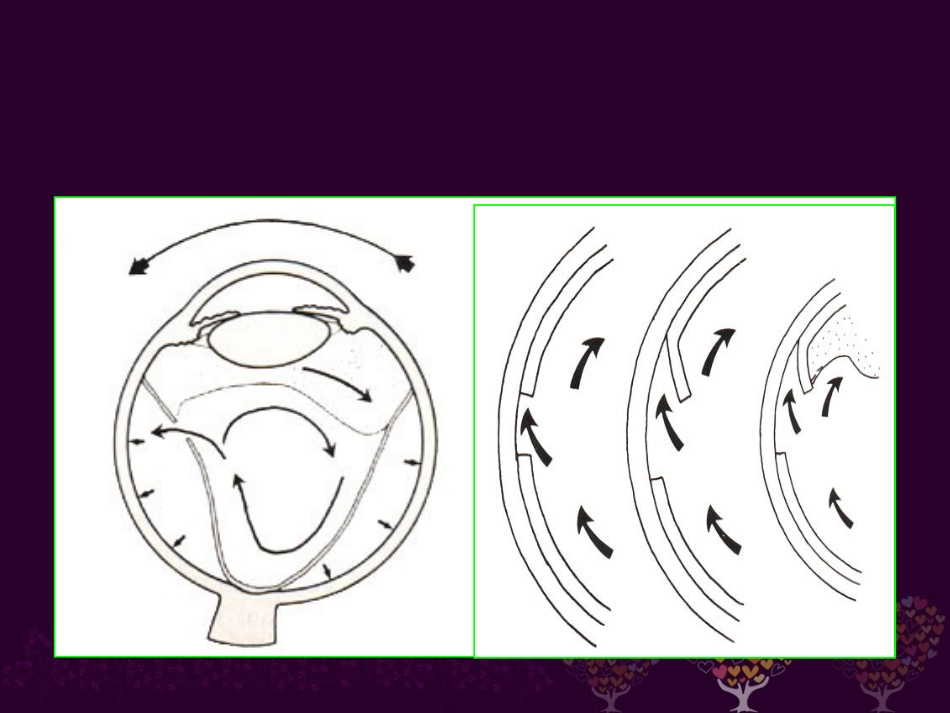 玻璃体病 _第11页