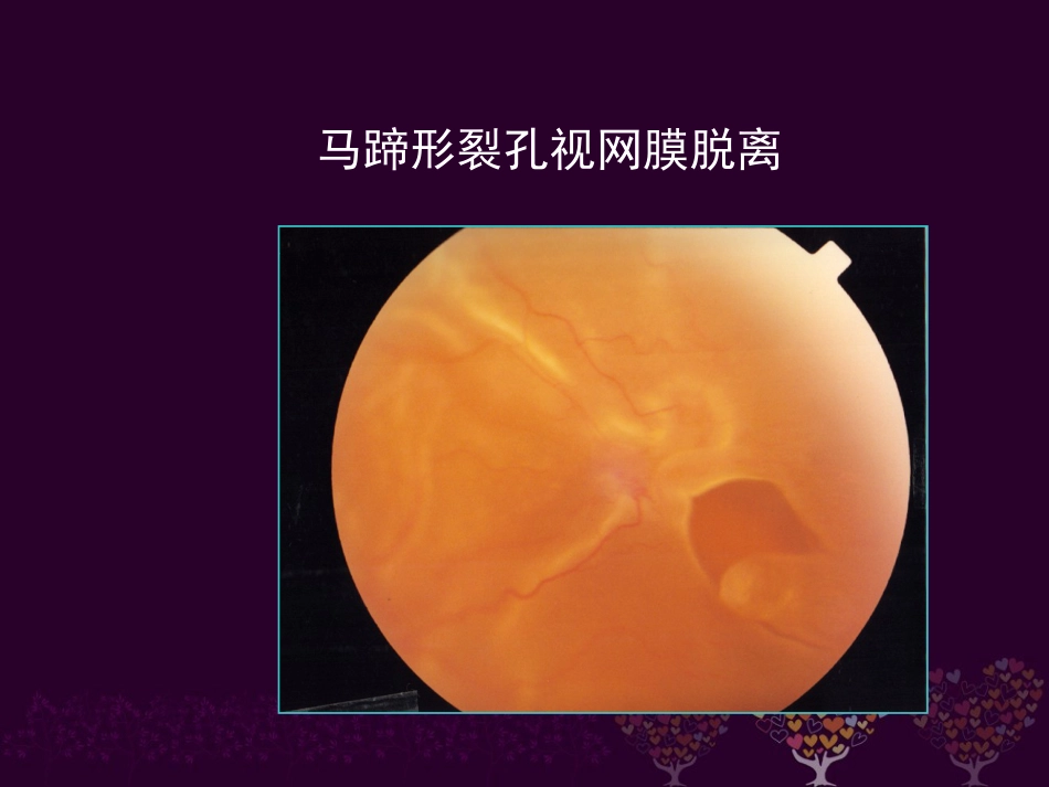 玻璃体病 _第12页
