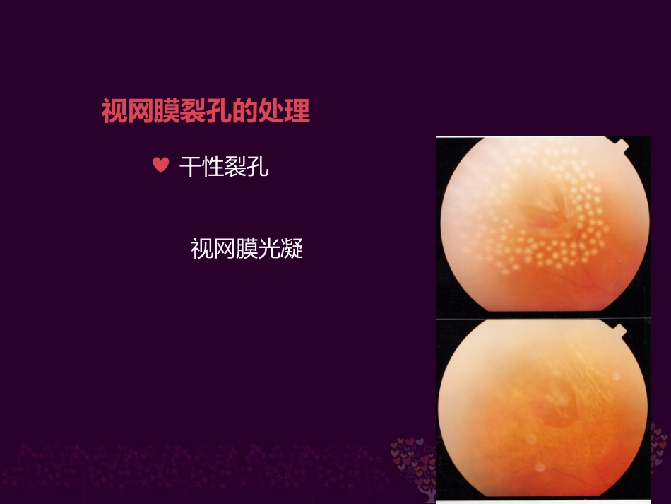 玻璃体病 _第13页