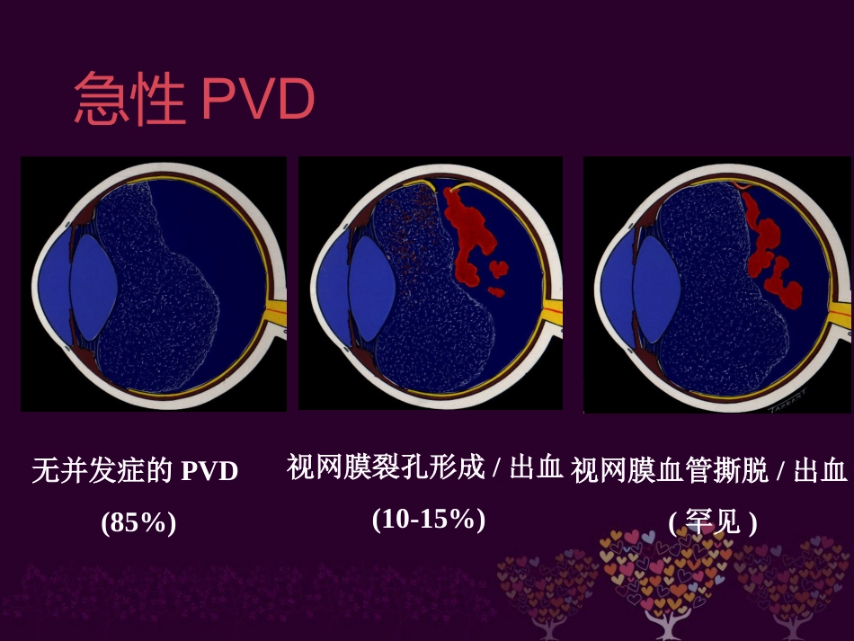 玻璃体病 _第9页
