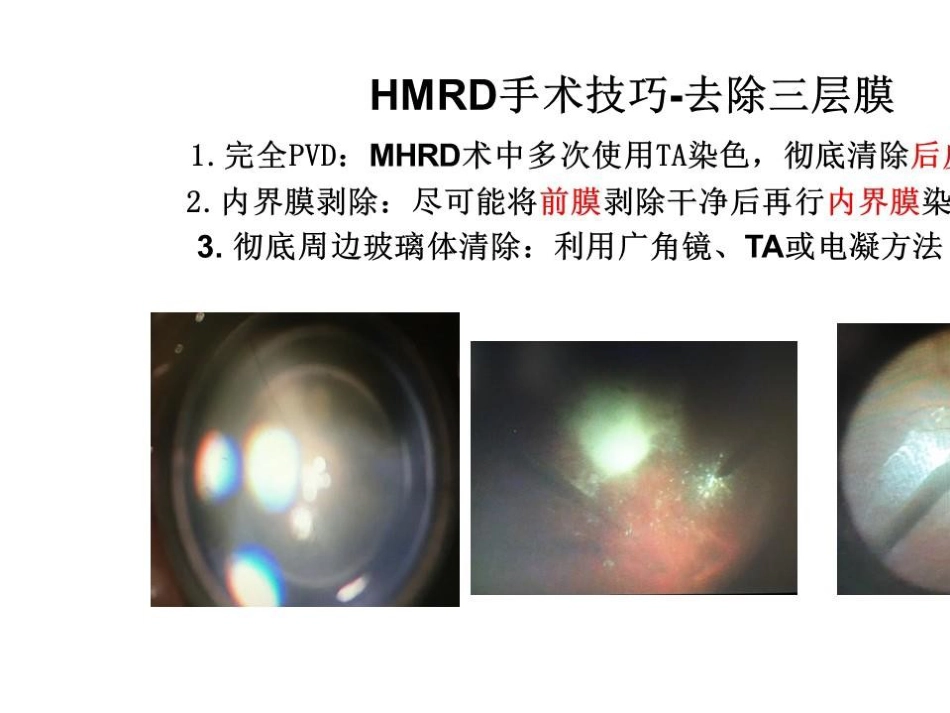 病理近视后巩膜葡萄肿合并黄斑裂孔视网膜脱离_第12页