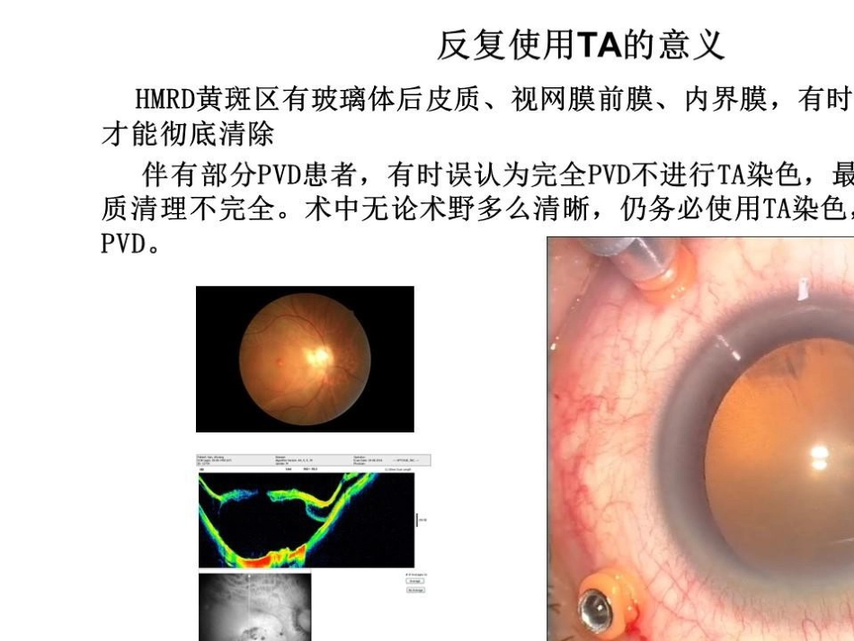 病理近视后巩膜葡萄肿合并黄斑裂孔视网膜脱离_第13页