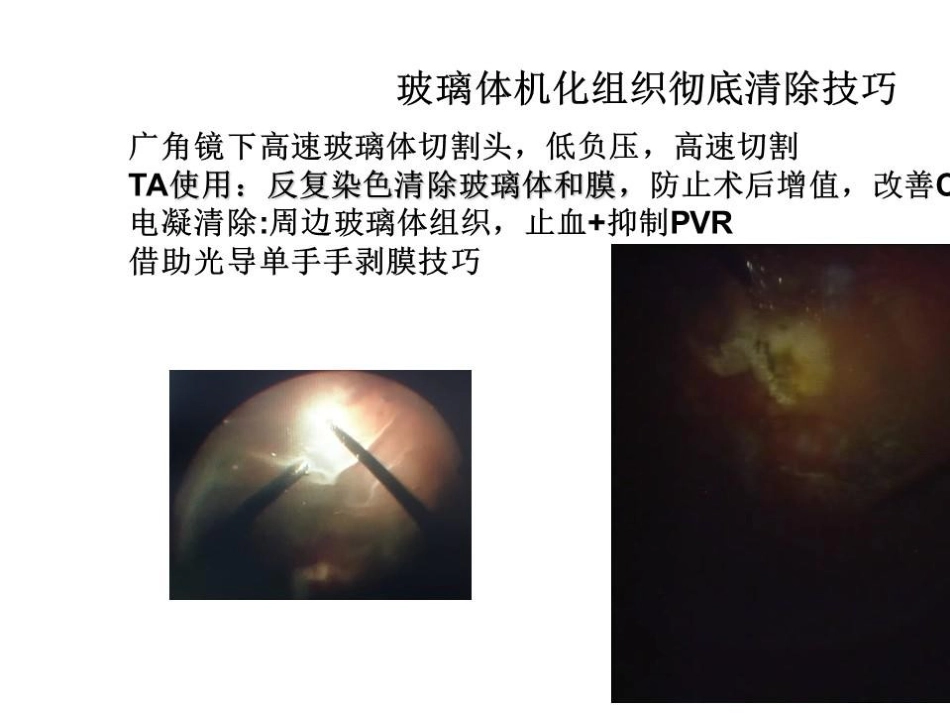 病理近视后巩膜葡萄肿合并黄斑裂孔视网膜脱离_第14页