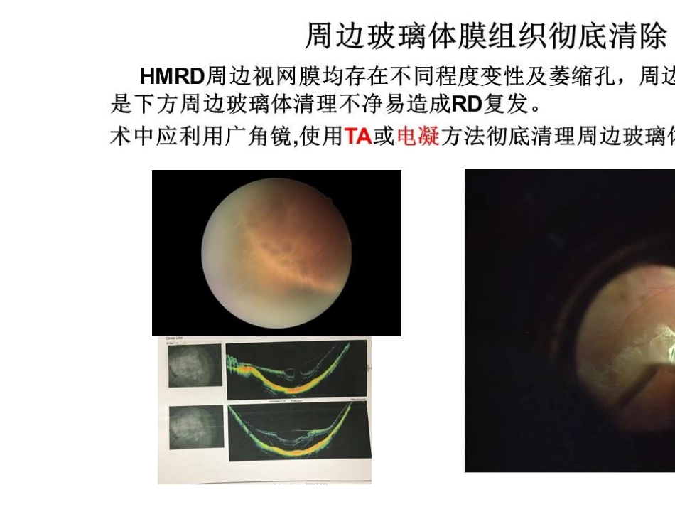 病理近视后巩膜葡萄肿合并黄斑裂孔视网膜脱离_第15页
