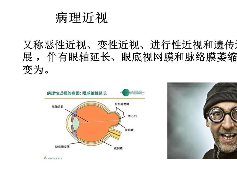 病理近视后巩膜葡萄肿合并黄斑裂孔视网膜脱离_第2页