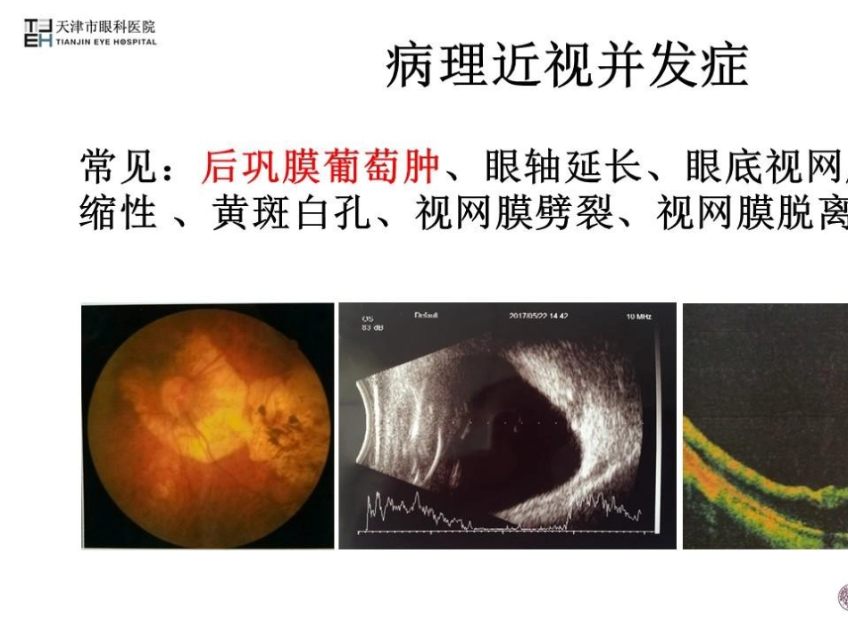 病理近视后巩膜葡萄肿合并黄斑裂孔视网膜脱离_第3页