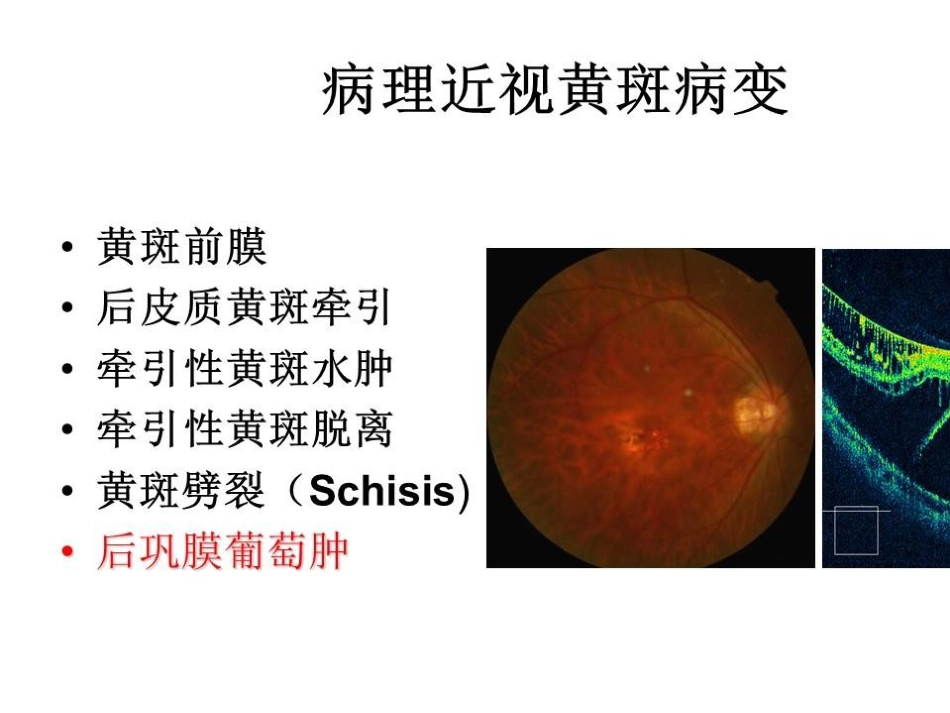 病理近视后巩膜葡萄肿合并黄斑裂孔视网膜脱离_第4页