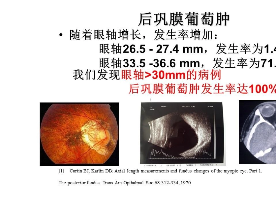 病理近视后巩膜葡萄肿合并黄斑裂孔视网膜脱离_第5页