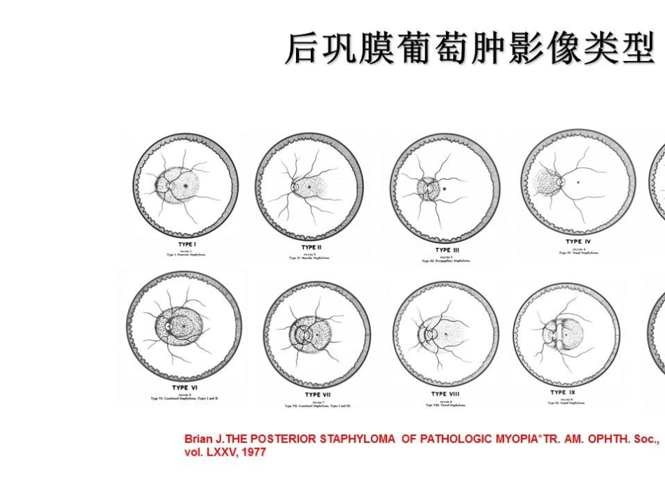 病理近视后巩膜葡萄肿合并黄斑裂孔视网膜脱离_第6页