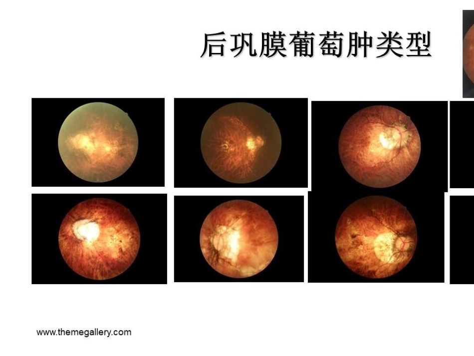 病理近视后巩膜葡萄肿合并黄斑裂孔视网膜脱离_第7页