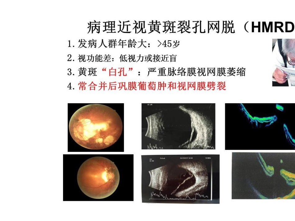 病理近视后巩膜葡萄肿合并黄斑裂孔视网膜脱离_第8页