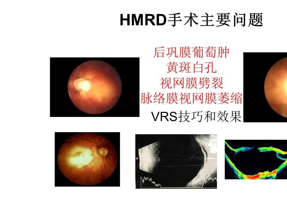 病理近视后巩膜葡萄肿合并黄斑裂孔视网膜脱离_第9页