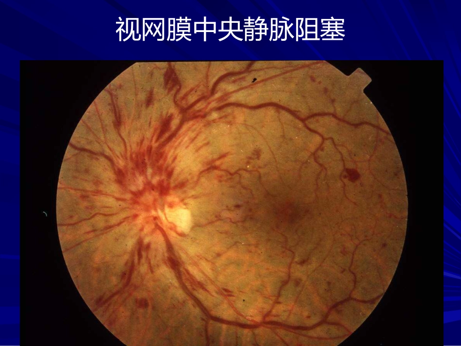 常见全身病的眼部表现_第7页