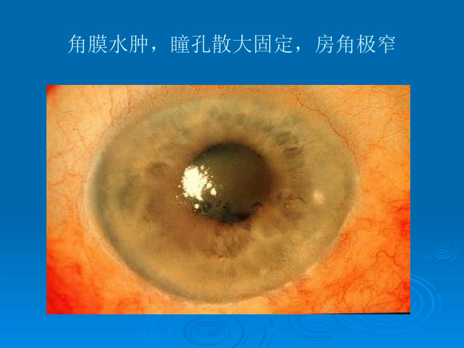 闭角型青光眼_第15页