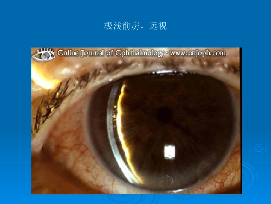 闭角型青光眼_第5页