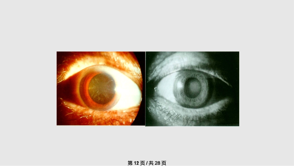 白内障概述_第12页