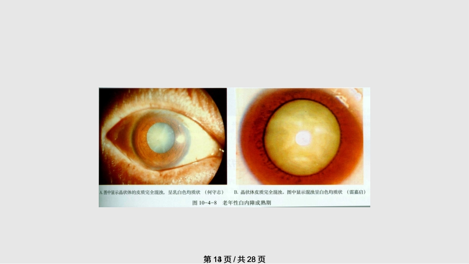 白内障概述_第14页