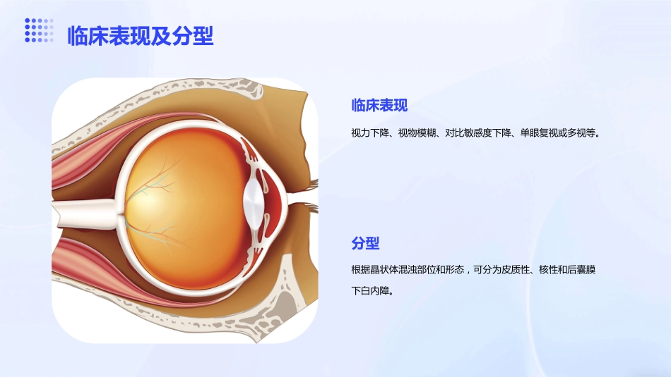 《老年性白内障》_第5页