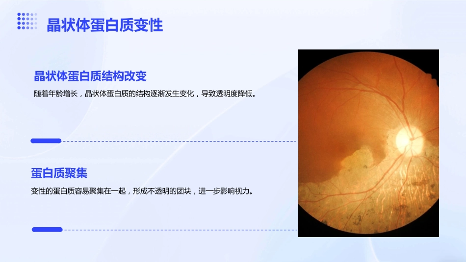 《老年性白内障》_第8页
