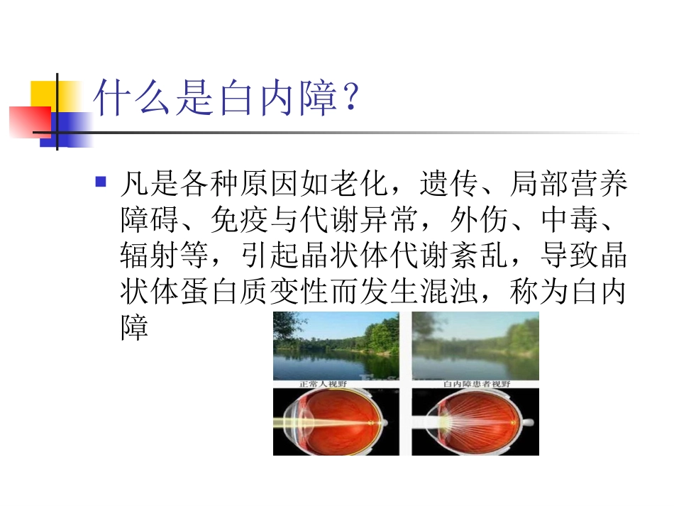 白内障超声乳化摘_第4页