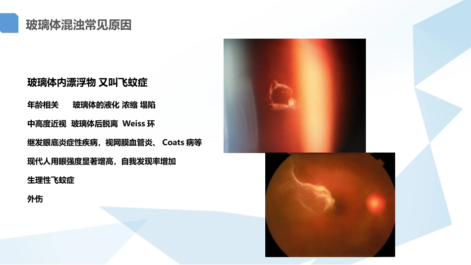 玻璃体混浊的激光消融治疗_第3页