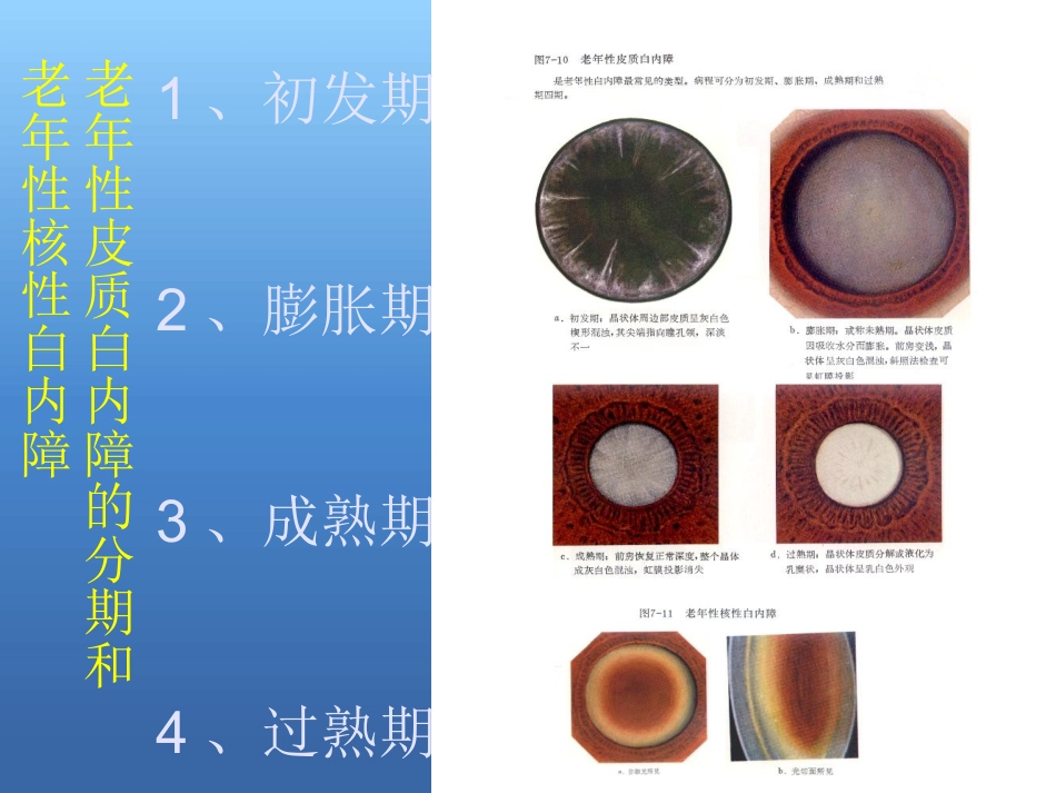 白内障的治疗讲解ppt_第10页
