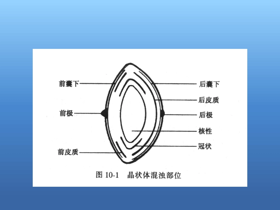 白内障的治疗讲解ppt_第4页