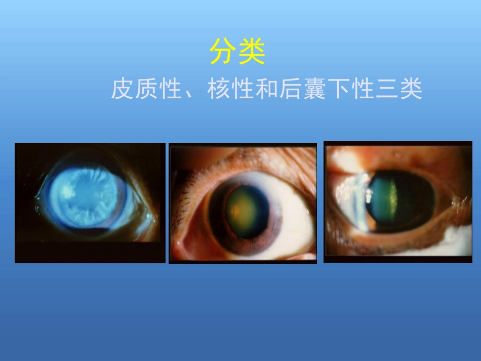 白内障的治疗讲解ppt_第9页